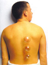 Cupping